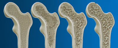 Osteoporosis