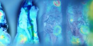 Novel quantitative kinetic metabolic PET methods may be the key to identifying early stage LVH disease.