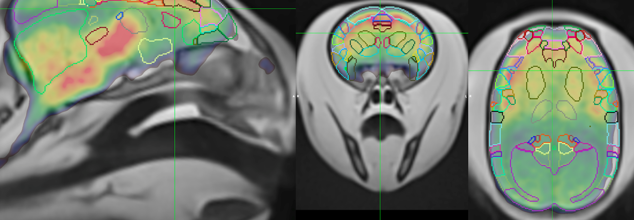 PET/CT and MR Neuroimaging Methods to Study Alzheimer’s Disease