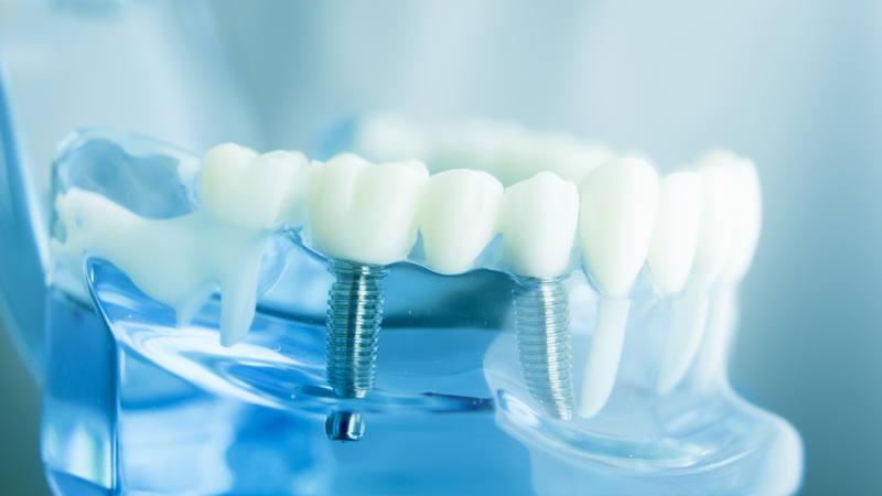 Medical-dental-implants-STOCK