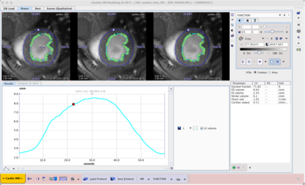 Streamlined cardiac function analysis leveraging AI-based segmentation in PMOD PCARDM. Epi- and endocardial contours are displayed and can be easily adjusted if necessary. The volume-cardiac-cycle curve is produced, and functional parameters tabulated.