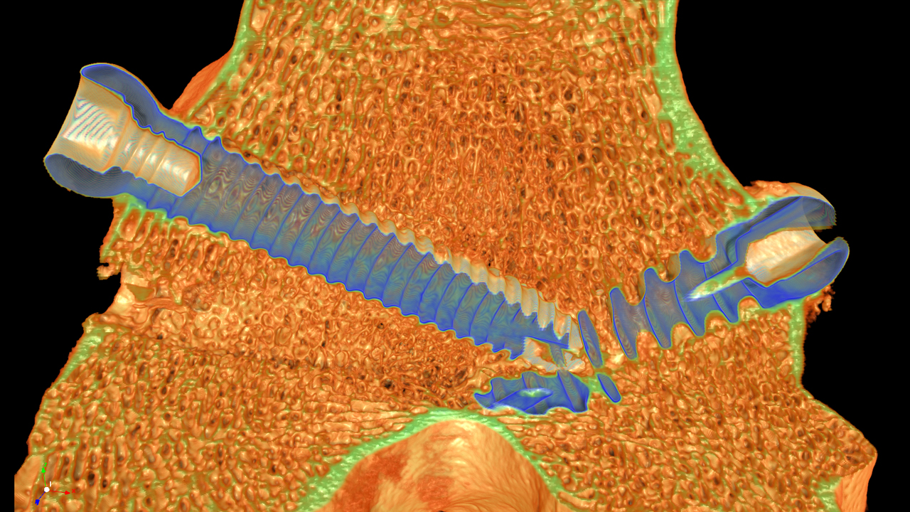 Adult sheep distal femur with inserted titanium screw implants, imaged at 30 μm voxel size.