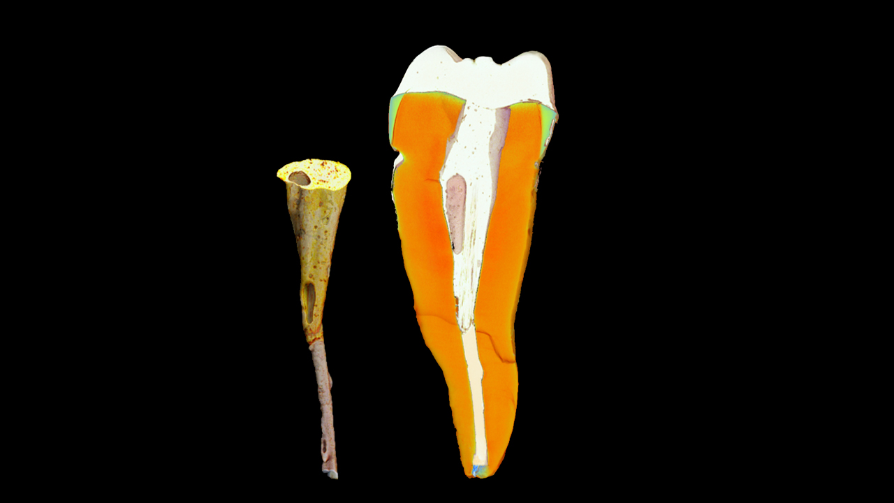 Human extracted tooth with filler imaged at 4 μm isotropic voxel size