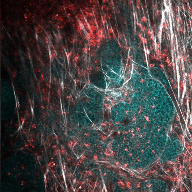 NADH Imaging of developing mammary tumors in vivo (MMTV-PyVT mouse model). Labels: NADH (red), GFP-CFMS (green), SHG (grey). 