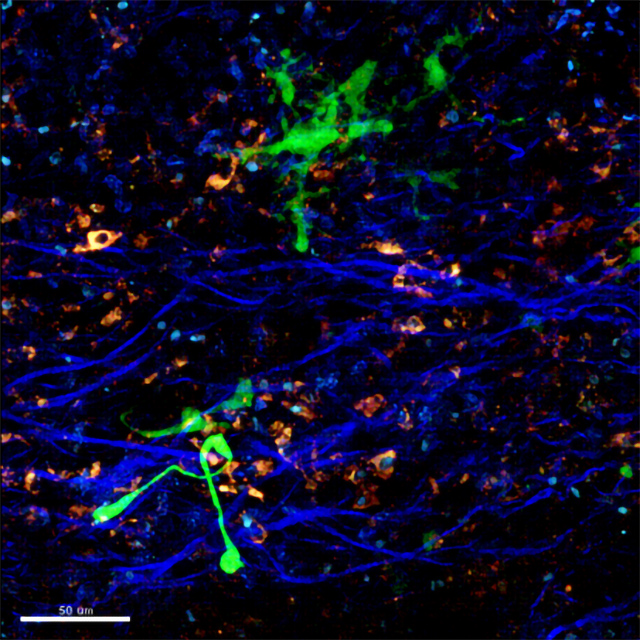 Two T cells (green) infected with a human immunodeficiency virus (HIV) amidst collagen fibers (blue, SHG) and autofluorescent cells (white/orange hues) in a lymph node
