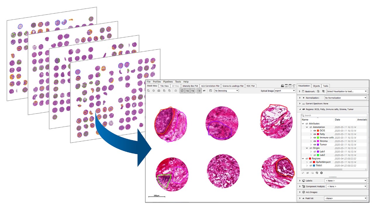 Statistical analysis with SCiLS Lab: Automatically group samples according to Metadata provided with experiments – perform classification and prediction with machine learning methods for tissue typing or biomarker discovery. ​