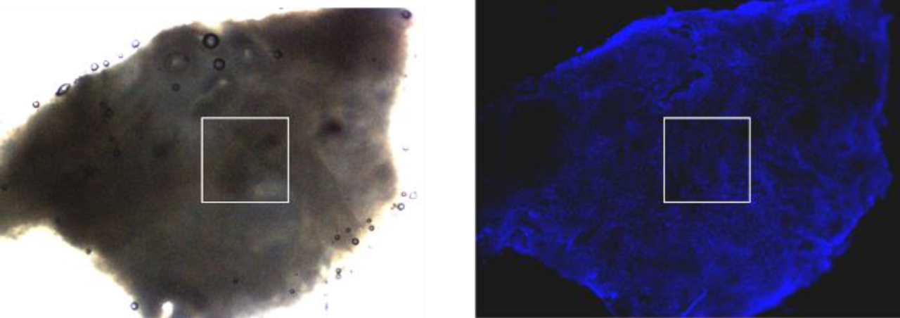 Fluorescence and transmission light images of human cervix tumor tissue captured with Zeiss AxioZoom V.16 macroscope. HOECHST staining highlights nuclei; white frames mark 1000 × 1000 µm² AFM mapping area.