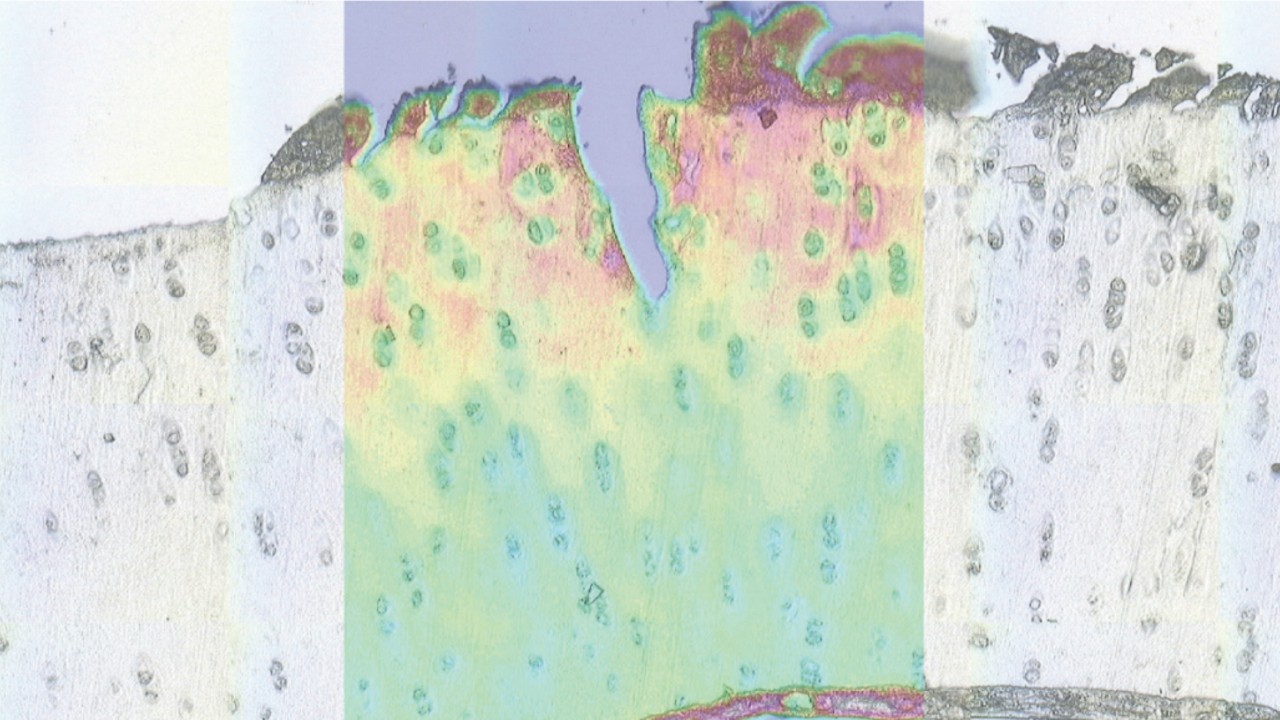 This image shows the microscopic image of tissue section of damaged cartilage. The low contrast image is enhanced by a superimposed infrared image showing proteins, lipids and carbohydrates.