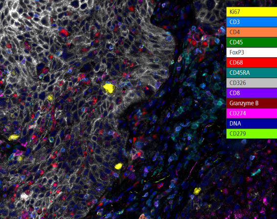 Fluorescent image of human lung cancer FFPE sample with 13 protein biomarkers illuminated using the Spatial Immune Profiling Kit for ChipCytometry. 