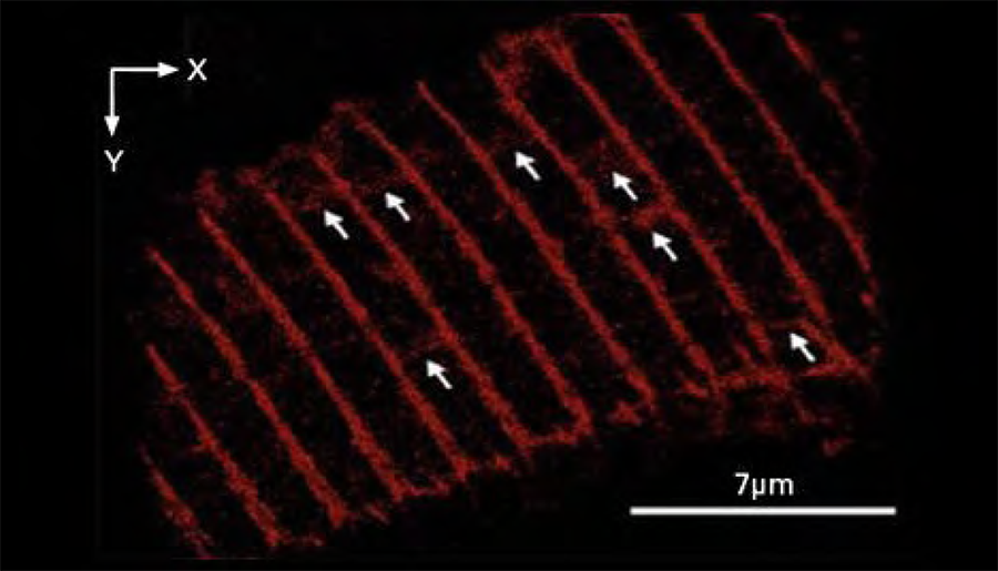 Image of Reduced alpha-actinin transverse fibers in cardiomyocytes associated with heart failure.