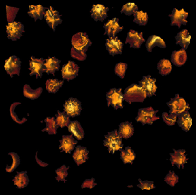 3D image of malaria-infected red blood cells captured with NanoWizard BioScience AFM.