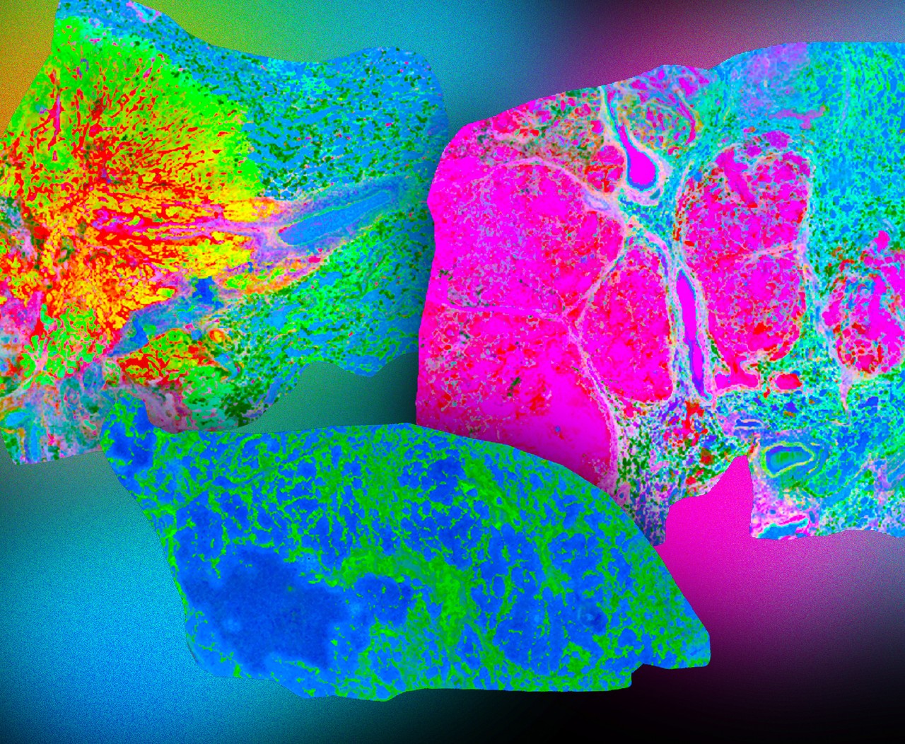 neofleX 116-pleX MALDI-HiPLEX IHC images on lung cancer samples: control, adenocarcinoma, squamous cell. Data courtesy Prof. Bernd Bodenmiller, U. of Zürich and ETH, Switzerland