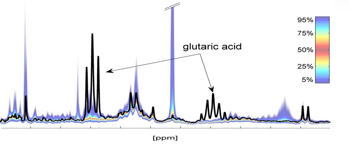 1H NMR spectrum of urine - comparison of individual spectral fingerprint (black) to reference ranges from a healthy population demonstrating a case of significant deviation.