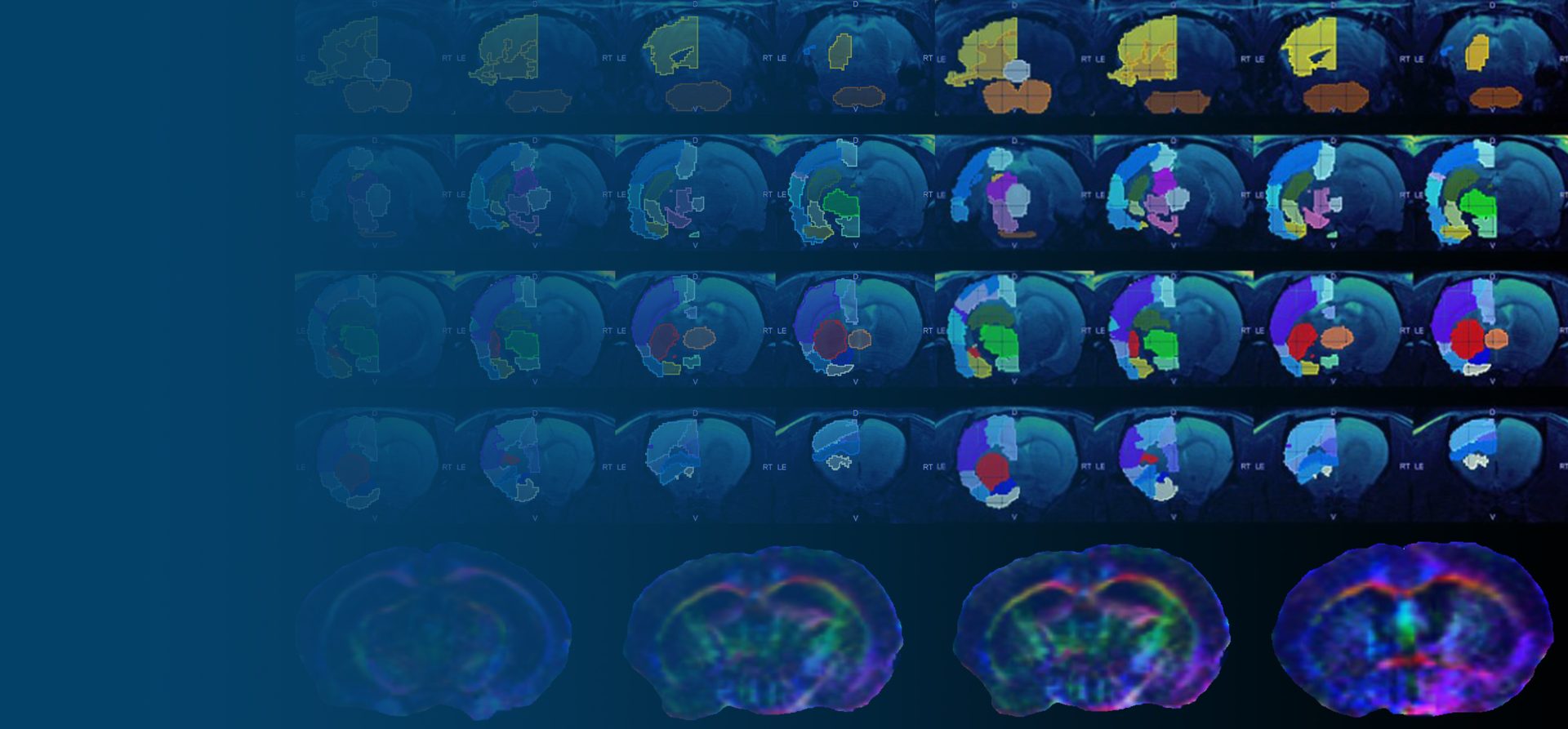 NMR based Lipoprotein Phenotyping reveals severity and recovery subgroups in populations infected by SARS-CoV-2