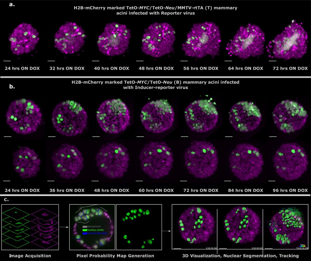 Light-sheet imaging of stochastic tumorigenesis in mammary acini.