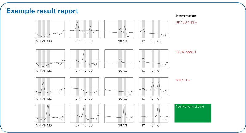 Example of a Fluorocycler® XT report for FluoroType® assay showing ‘results at a glance’ generated by FluoroSoftware® XT-IVD.